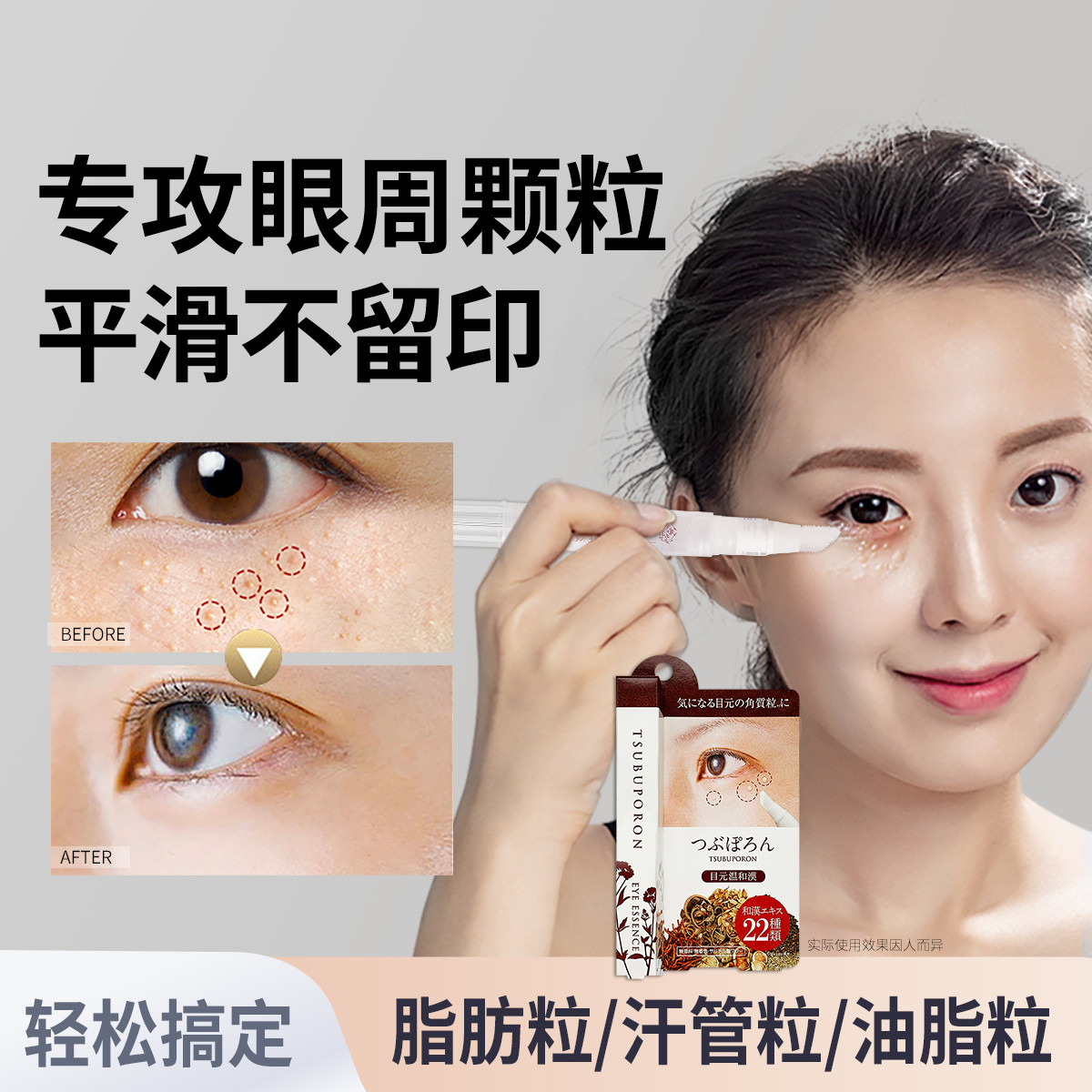 SLINKYTOUCH 日本美人姬去除脂肪粒汗管瘤神器脸部眼周去油脂粒专用眼霜精华液