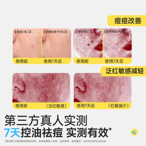 润本 【青少年控油祛痘】学生根源祛痘精华水闭口水青春期祛痘精华乳 图片 9